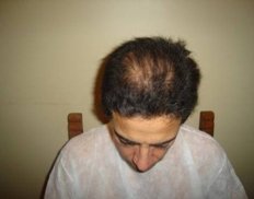 Slider image (5) Vita Hair | Clinica Capilar